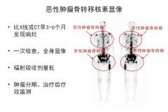 999全讯白菜网核医学科骨检查与治疗